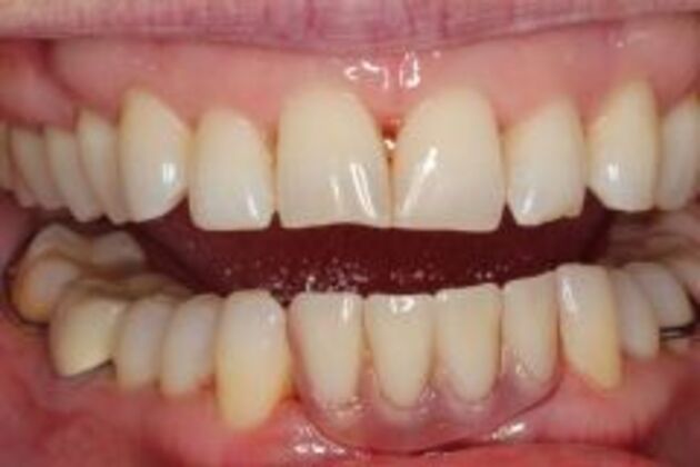 Dentures Case 2 - After