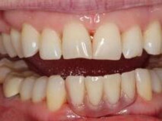 Dentures: Case 2 - After