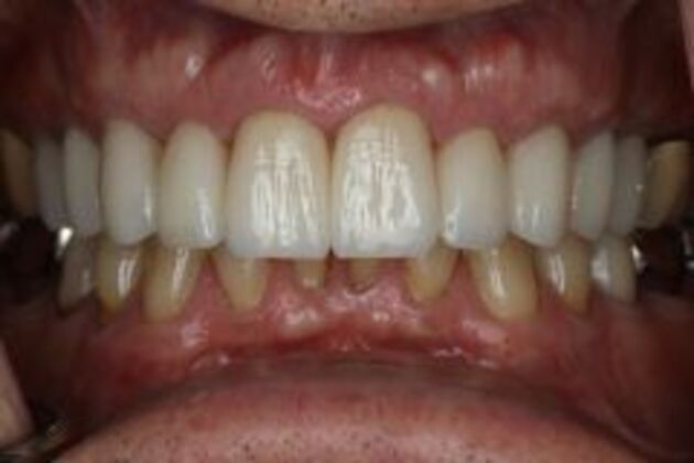 Dental Crowns Case 1 - Before