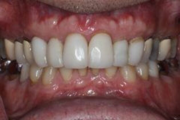 Dental Crowns Case