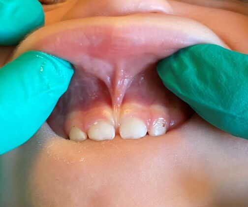 Lip Tie Case 1 - Before