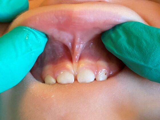 Lip Tie Case 1 - Before
