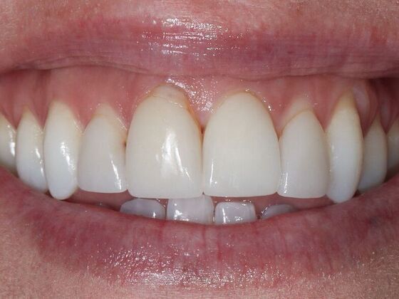 Smile Makeover & Veneers: Christie - Before