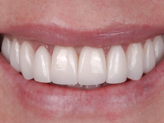 Smile Makeover & Veneers: Christie - After