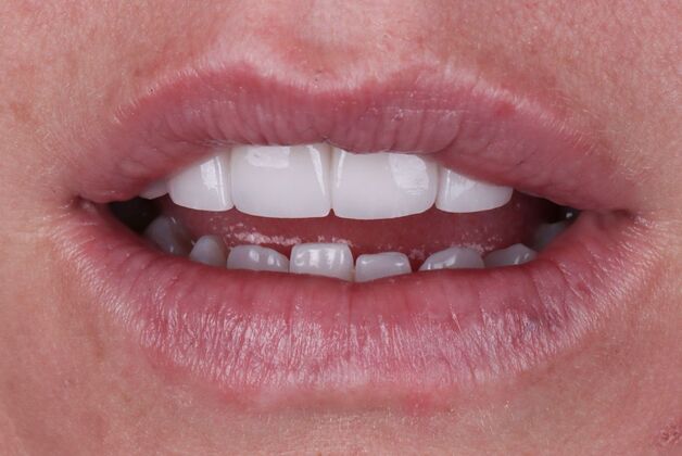 Smile Makeover & Veneers Christie