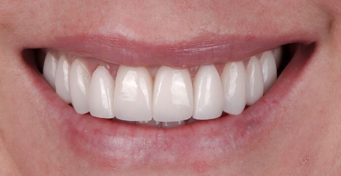 Smile Makeover & Veneers: Christie - After