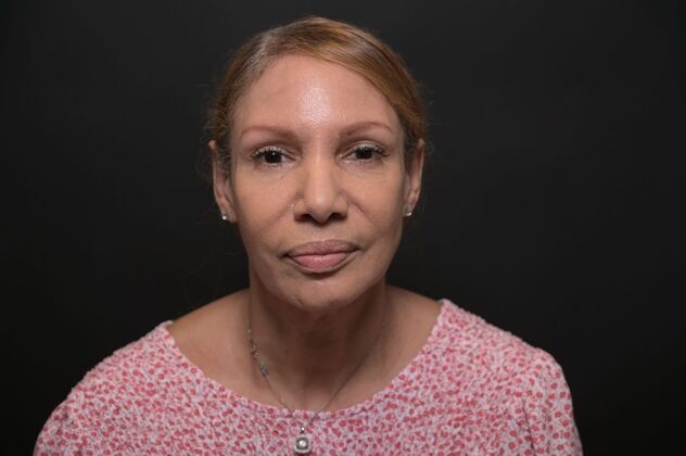 Facial Rejuvenation: FaceTite with Morpheus8 Face and Neck - Before