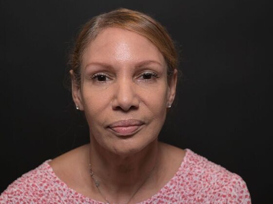 Facial Rejuvenation: FaceTite with Morpheus8 Face and Neck - Before