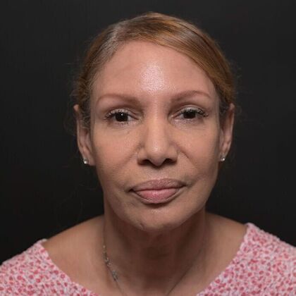 Facial Rejuvenation: FaceTite with Morpheus8 Face and Neck - Before