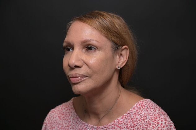 Facial Rejuvenation: FaceTite with Morpheus8 Face and Neck - Before