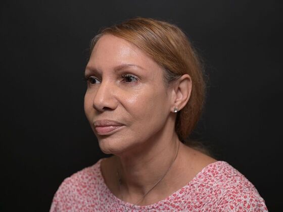 Facial Rejuvenation: FaceTite with Morpheus8 Face and Neck - Before