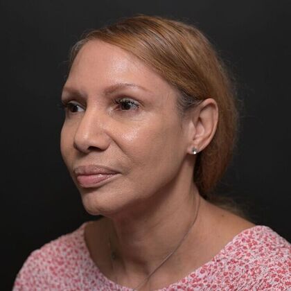 Facial Rejuvenation: FaceTite with Morpheus8 Face and Neck - Before