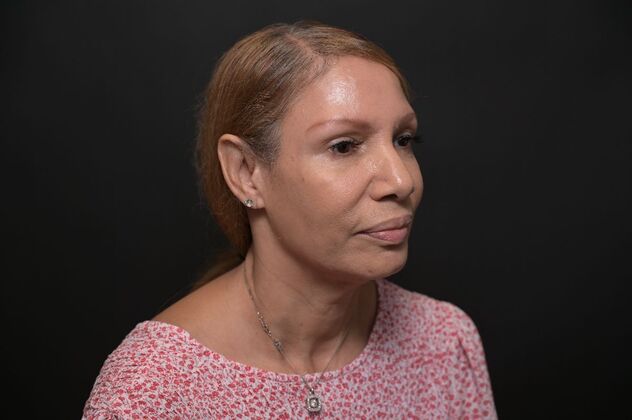 Facial Rejuvenation: FaceTite with Morpheus8 Face and Neck - Before