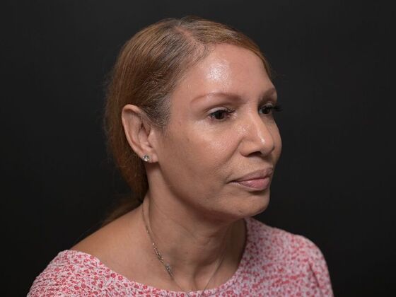 Facial Rejuvenation: FaceTite with Morpheus8 Face and Neck - Before