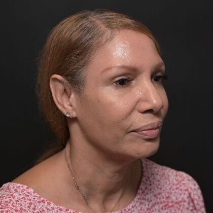 Facial Rejuvenation: FaceTite with Morpheus8 Face and Neck - Before