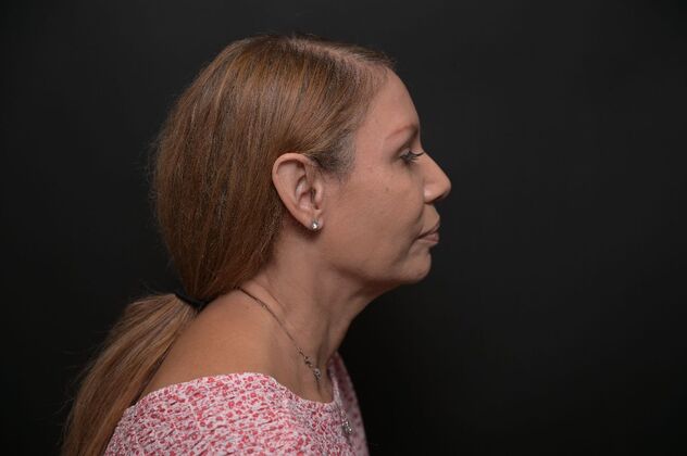 Facial Rejuvenation: FaceTite with Morpheus8 Face and Neck - Before