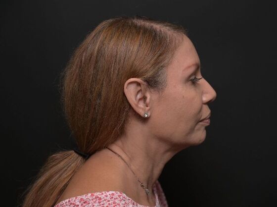 Facial Rejuvenation: FaceTite with Morpheus8 Face and Neck - Before