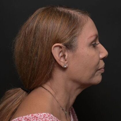Facial Rejuvenation: FaceTite with Morpheus8 Face and Neck - Before