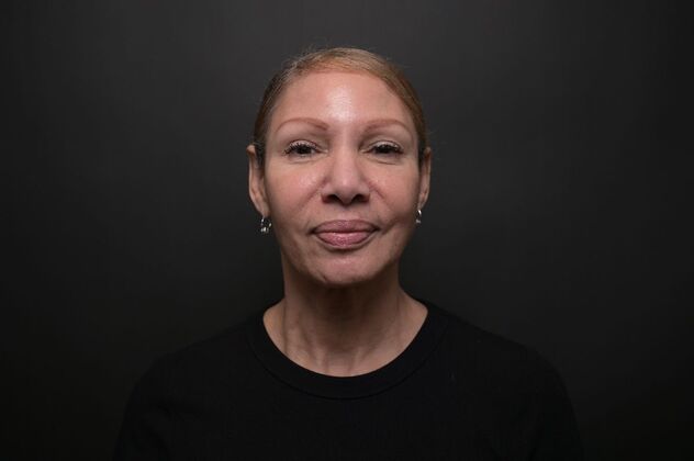 Facial Rejuvenation: FaceTite with Morpheus8 Face and Neck - After