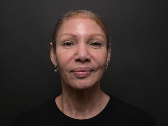 Facial Rejuvenation: FaceTite with Morpheus8 Face and Neck - After