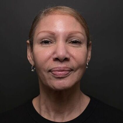 Facial Rejuvenation: FaceTite with Morpheus8 Face and Neck - After