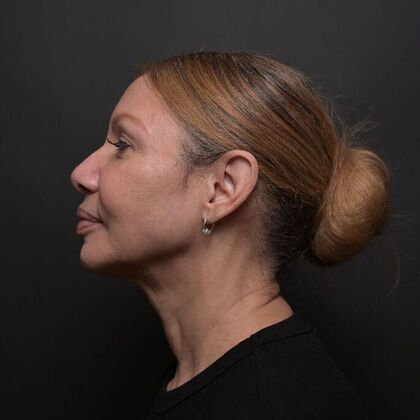 Facial Rejuvenation FaceTite with Morpheus8 Face and Neck - After