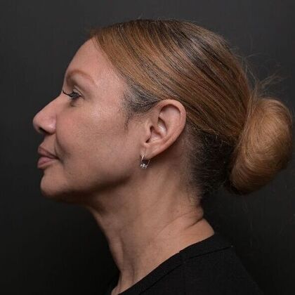 Facial Rejuvenation FaceTite with Morpheus8 Face and Neck - After