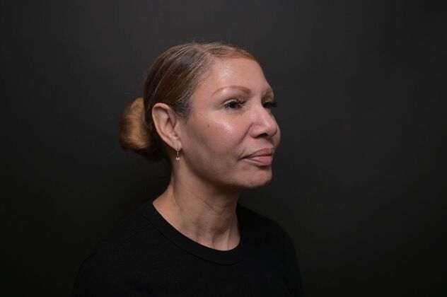 Facial Rejuvenation: FaceTite with Morpheus8 Face and Neck - After