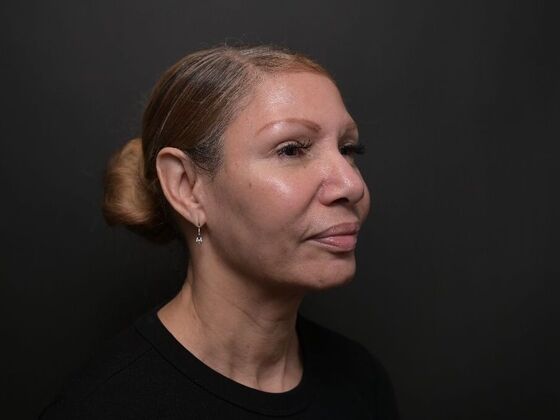 Facial Rejuvenation: FaceTite with Morpheus8 Face and Neck - After