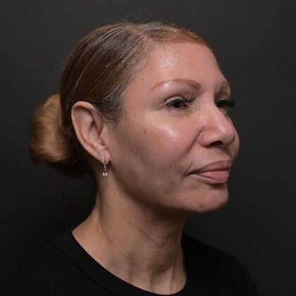 Facial Rejuvenation: FaceTite with Morpheus8 Face and Neck - After