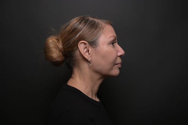 Facial Rejuvenation: FaceTite with Morpheus8 Face and Neck - After