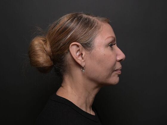 Facial Rejuvenation: FaceTite with Morpheus8 Face and Neck - After