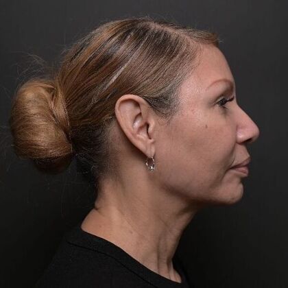Facial Rejuvenation: FaceTite with Morpheus8 Face and Neck - After