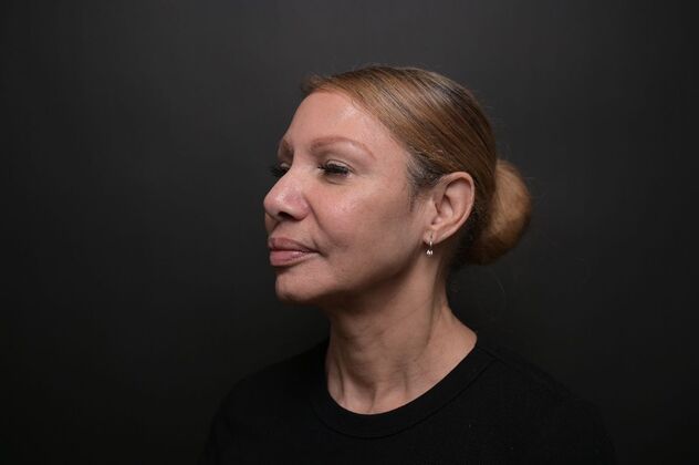 Facial Rejuvenation: FaceTite with Morpheus8 Face and Neck - After