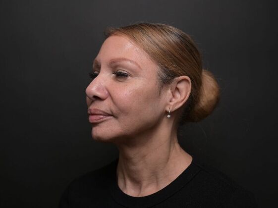 Facial Rejuvenation: FaceTite with Morpheus8 Face and Neck - After