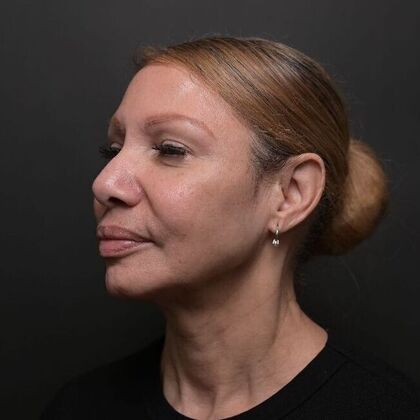 Facial Rejuvenation: FaceTite with Morpheus8 Face and Neck - After