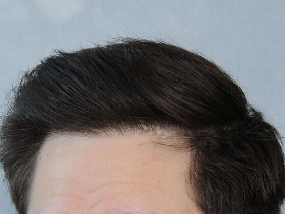 Hair Transplant Results: Case 2 - After