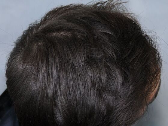 Hair Transplant Results: Case 2 - After