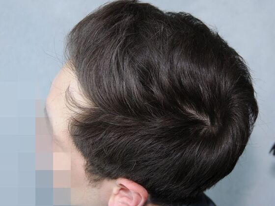 Hair Transplant Results: Case 2 - After