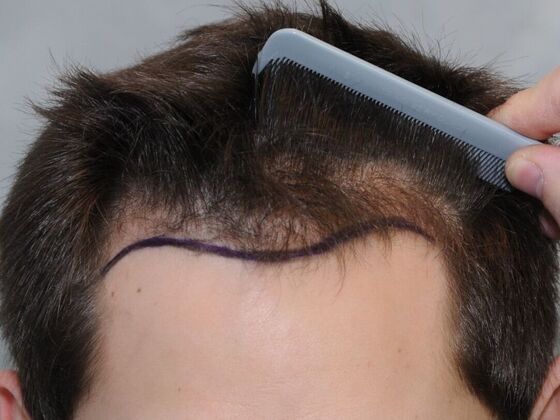 Hair Transplant Results Case 2 - Before