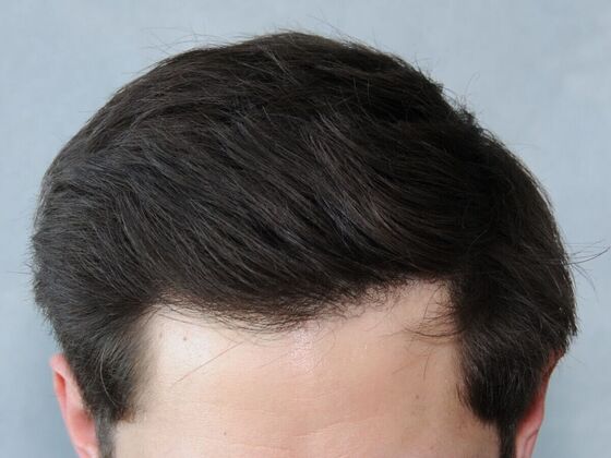 Hair Transplant Results Case 2 - After