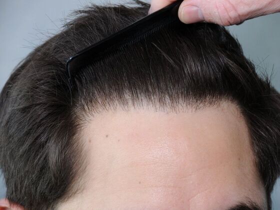 Hair Transplant Results: Case 2 - After