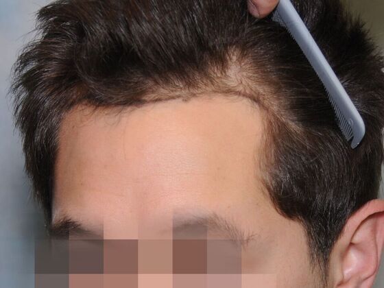 Hair Transplant Results: Case 2 - Before