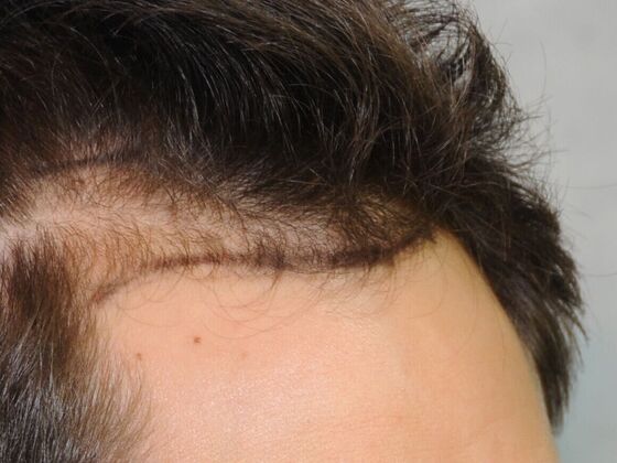 Hair Transplant Results: Case 2 - Before