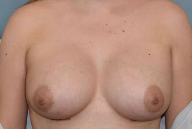 Breast Augmentation Case 780 - After