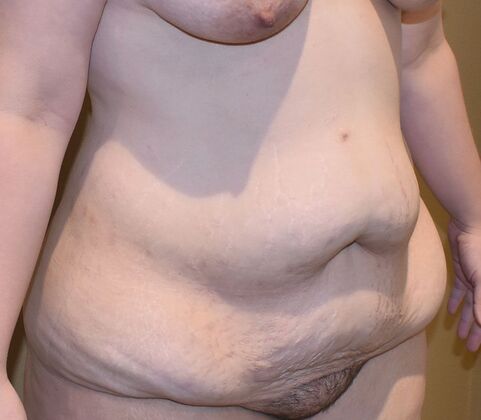 Tummy Tuck (Abdominoplasty): Case 514 - Before