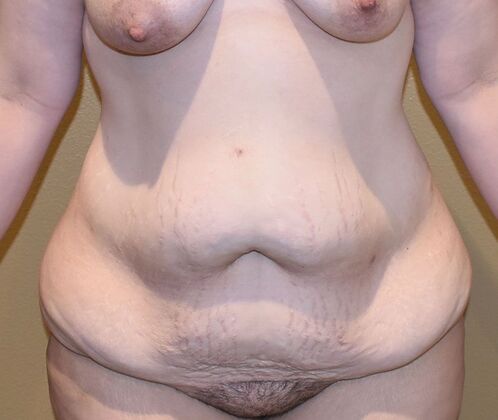 Massive Weight Loss : Case 163 - Before