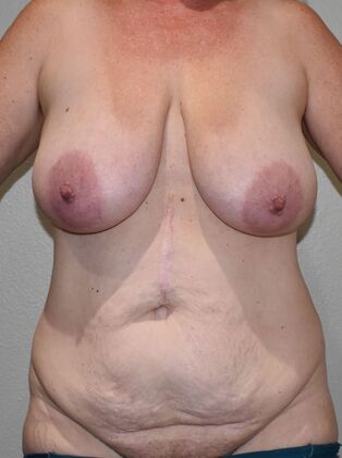 Mommy Makeover Case 327 - Before