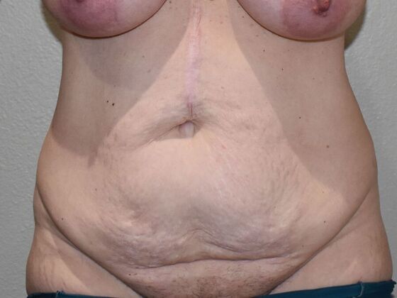 Tummy Tuck (Abdominoplasty): Case 515 - Before