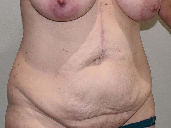Tummy Tuck (Abdominoplasty): Case 515 - Before